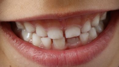 Qu’est-ce que le MIH, cette maladie qui détruit l’émail des dents des enfants et favorise les caries ?